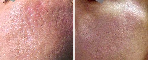 acne_scars_dr_luppino (2)