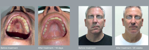 herpes_zoster_infection_b_a2