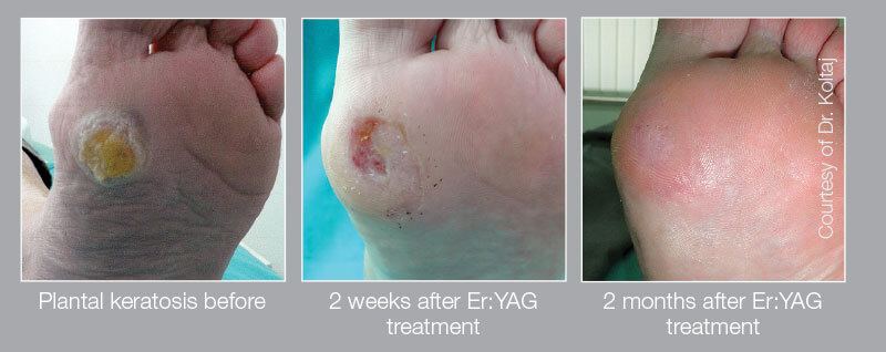 keratosis