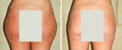 lipolysis2_dr_maletic