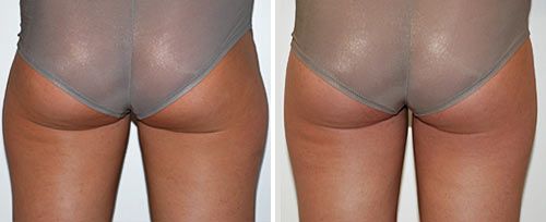 lipolysis_dr_leibaschoff