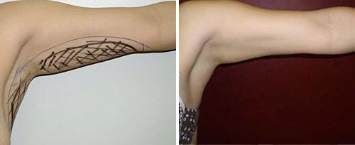 lipolysis_dr_maletic