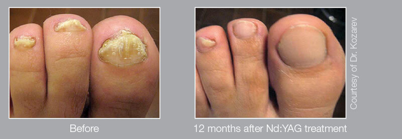 onychomycosis