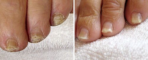 onychomycosis_sult_rn