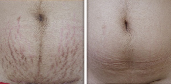 striae_1