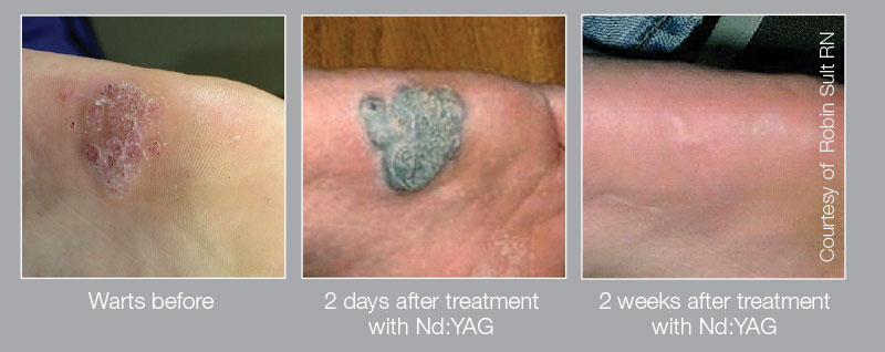 warts